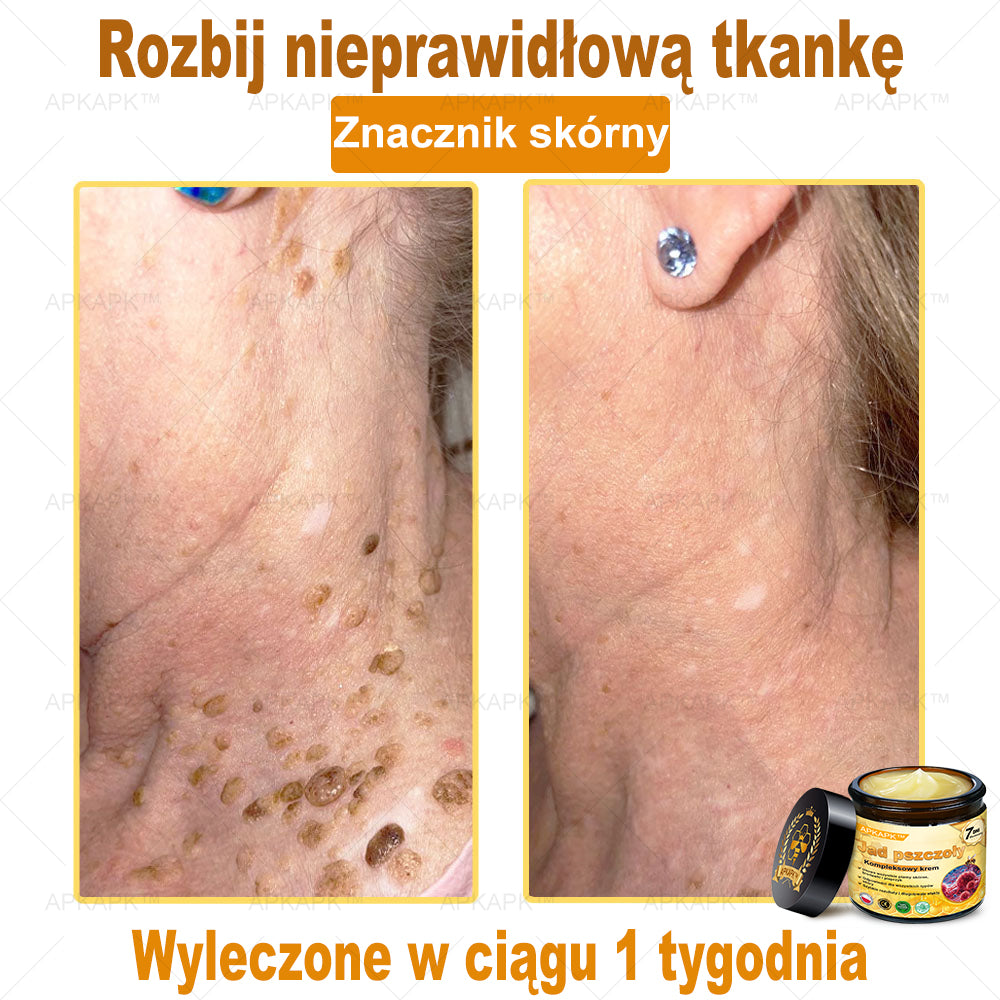ΑPΚΑPK™ Jad Pszczoły Kompleksowy Krem🥇🥇🥇pomaga w leczeniu problemów skórnych, takich jak: zmarszczki, blizny, plamy pigmentacyjne, rozstępy, trądzik, łuszczyca, egzema, zmiany skórne, podrażnienia, stany zapalne i inne problemy skórne🔥