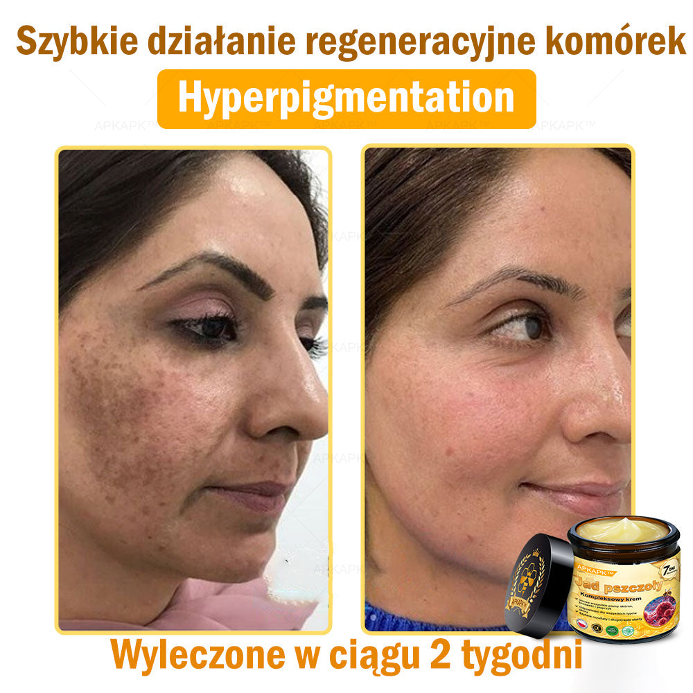 ΑPΚΑPK™ Jad Pszczoły Kompleksowy Krem🥇🥇🥇pomaga w leczeniu problemów skórnych, takich jak: zmarszczki, blizny, plamy pigmentacyjne, rozstępy, trądzik, łuszczyca, egzema, zmiany skórne, podrażnienia, stany zapalne i inne problemy skórne🔥