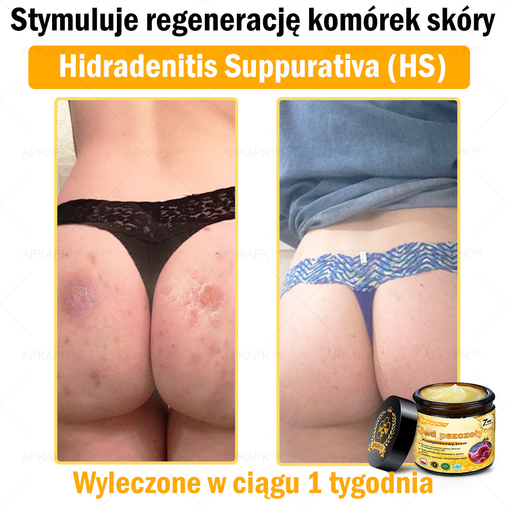 ΑPΚΑPK™ Jad Pszczoły Kompleksowy Krem🥇🥇🥇pomaga w leczeniu problemów skórnych, takich jak: zmarszczki, blizny, plamy pigmentacyjne, rozstępy, trądzik, łuszczyca, egzema, zmiany skórne, podrażnienia, stany zapalne i inne problemy skórne🔥